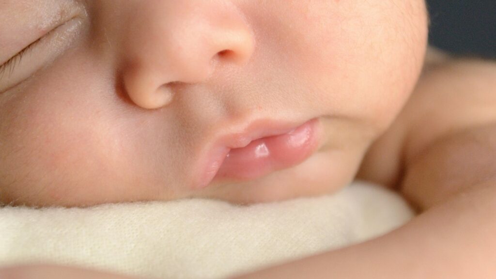 how to prevent severe hyperbilirubinemia, newborn jaundice 2026